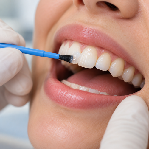 Imagen ilustrativa: Barniz de flúor — Clarity Dental