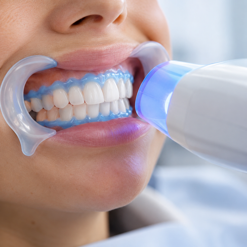 Imagen ilustrativa de blanqueamiento dental — Clarity Dental