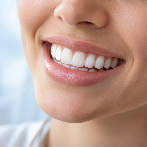 Imagen ilustrativa: Carilla de resina (Directa en clínica) — Clarity Dental